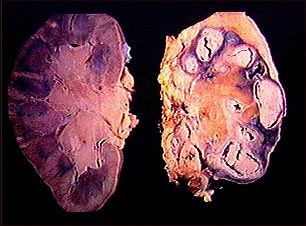 Tuberculosis renal