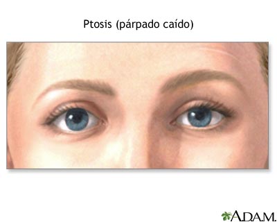 Descenso del párpado por ptosis