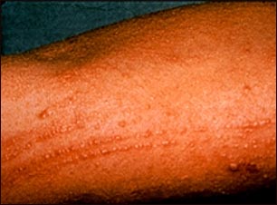Erupción por roble venenoso en el brazo