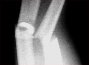 Fractura, antebrazo - Rayos X