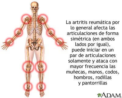 Artritis reumatoide
