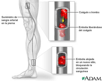 Embolia arterial