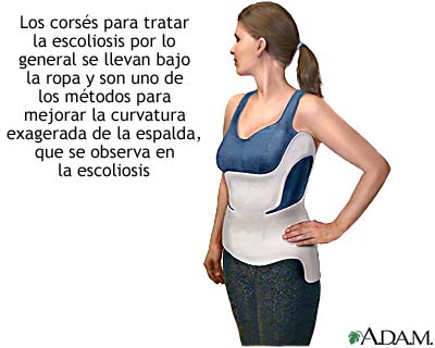 Corsé para escoliosis