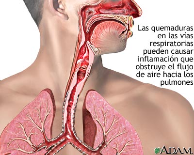 Quemadura de las vías respiratorias