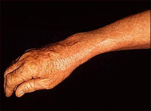 Léntigo solar con eritema en el brazo