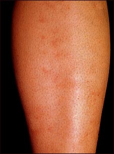 Poliarteritis microscópica en la espinilla