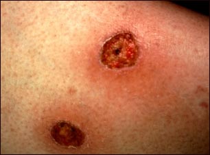 Ectima gangrenoso