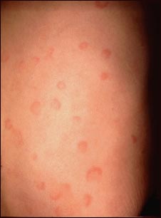 Urticaria en la espalda