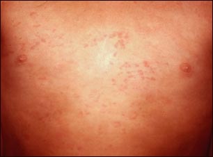 Urticaria en el tórax