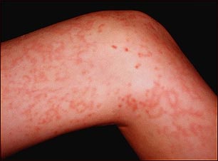 Granulomatosis de Wegener en la pierna