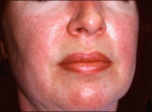 Dermatomiositis; erupción heliotrope en la cara