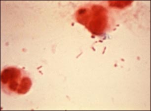 Haemophilus influenzae