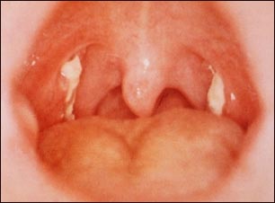 Mononucleosis: vista de la garganta