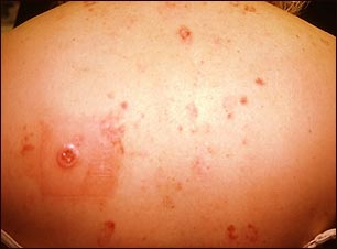 Cáncer múltiple de célula basal por terapia con rayos X para el acné