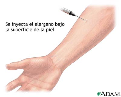 Prueba cutánea de antígeno de Aspergillus