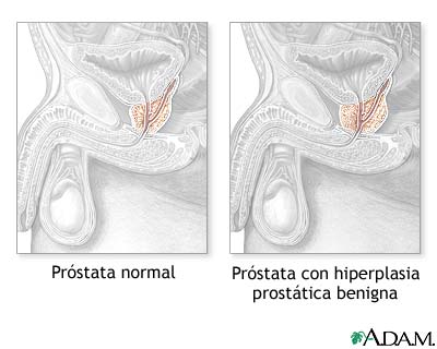Hiperplasia