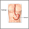 Colocación de un tubo de gastrostomía - Serie