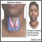 Enfermedad de Hashimoto (tiroiditis crónica)