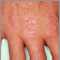 Dermatomiositis, pápulas de Gottron en las manos