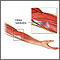 Tendinitis