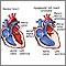 Síndrome del corazón izquierdo hipoplásico