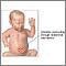 Hernia abdominal infantil (gastrosquisis)