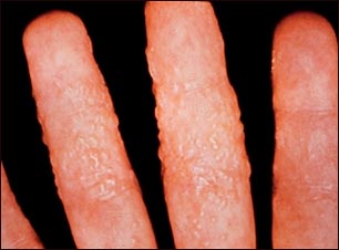 Dermatitis como reacción a la tiña