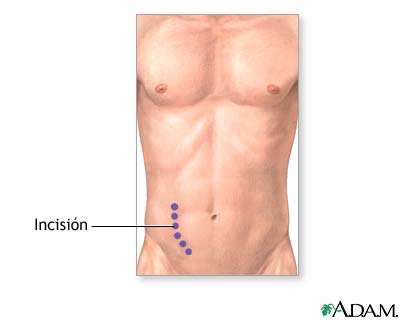 Incisi&oacute;n