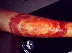 Eritema crónico migratorio en la enfermedad de Lyme