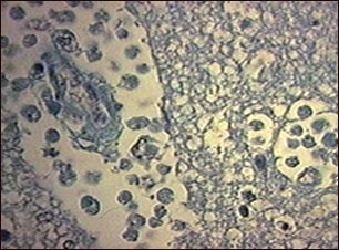 Absceso cerebral amebiano