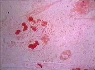 Haemophilus influenzae