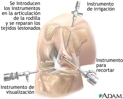 Artroscopia