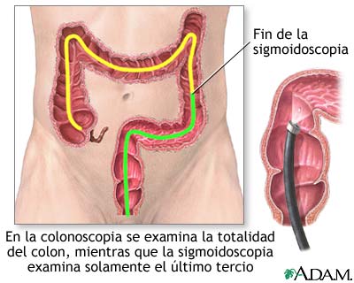 Colonoscopia