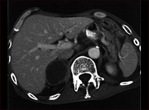 Metástasis suprarrenal -TC