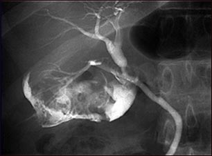 Colangiograma de una colecistitis