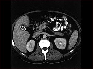 Colecistolitiasis
