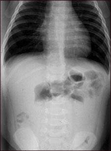 Radiografía de una invaginación