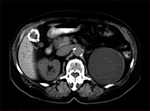 Quiste renal con cálculos biliares; TC