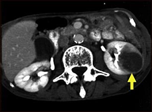 Met&aacute;stasis del ri&ntilde;&oacute;n - TC