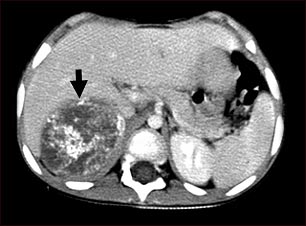Tomografía computarizada de neuroblastoma en el hígado