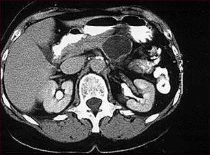 Adenoma quístico del páncreas; TC