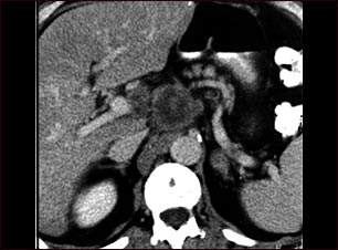 Cáncer pancreático, TC