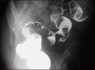 Rayos X de c&aacute;ncer de colon sigmoide