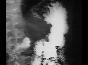 Rayos X de un cáncer de estómago