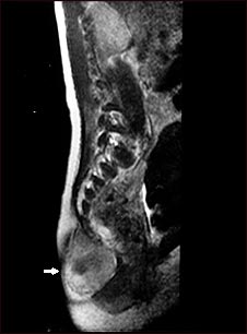 Teratoma - IRM