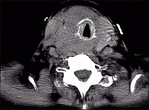Tomografía computarizada de cáncer de tiroides