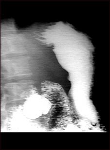 Radiografía de úlcera estomacal