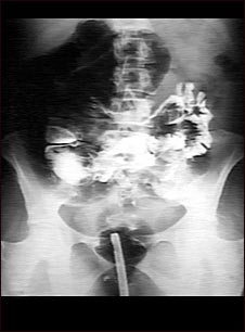 Radiografía de vólvulo