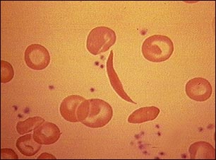 Glóbulos rojos drepanocíticos