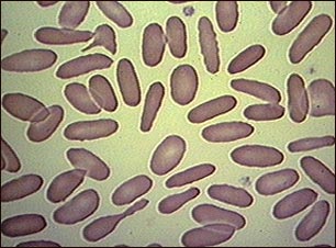 Glóbulos rojos con eliptocitosis